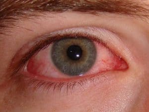 تصویری از یک فرد مبتلا به ورم ملتحمه چشم